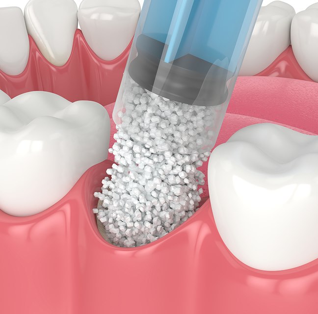 Bone Grafting