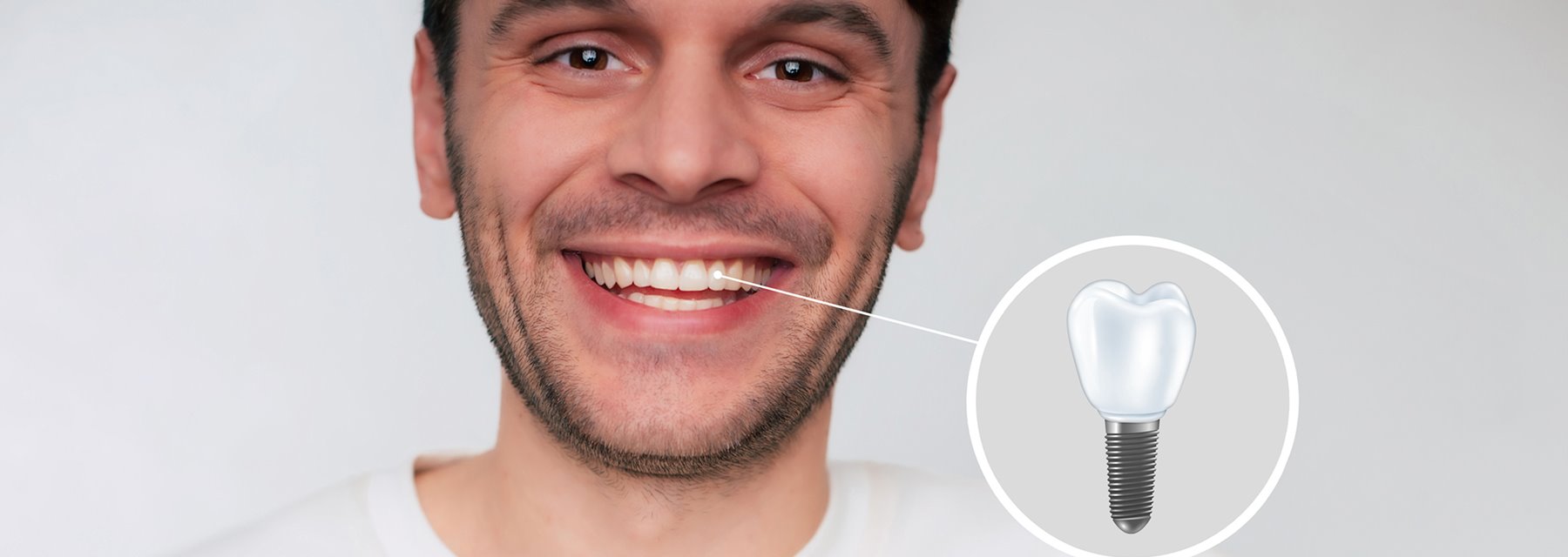 Dental Implants Popular Choices for Replacing Missing Teeth